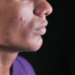 Fungal Acne in Malaysia: Why Your Skin Won’t Clear Up