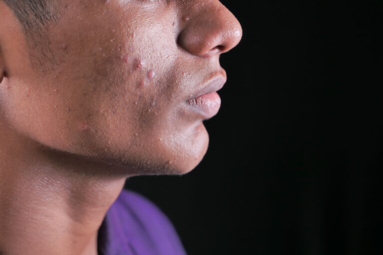 Photo by Towfiqu barbhuiya: https://www.pexels.com/photo/a-man-with-pimples-on-his-cheek-8589763/